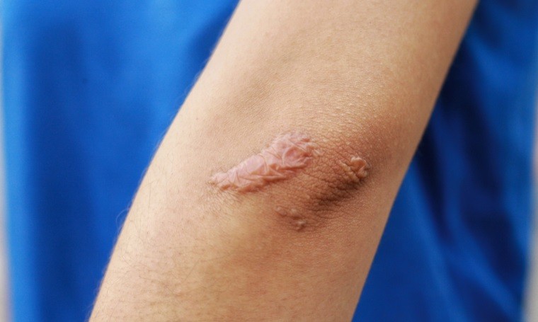 Luka di Kulit Timbulkan Keloid, Apa Penyebabnya?