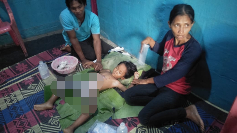 Terbakar akibat Main Korek Api, Bocah di Lampung Butuh Biaya Berobat