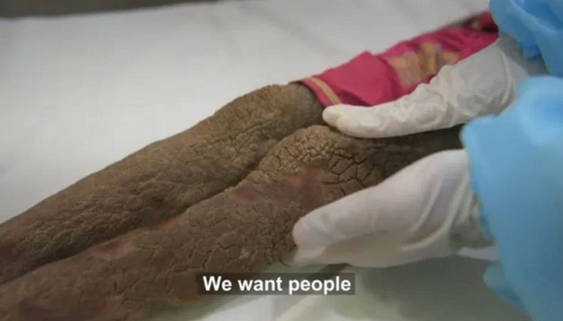 Penyakit Aneh, Kulit Bocah Perempuan Ini Keras seperti Batu