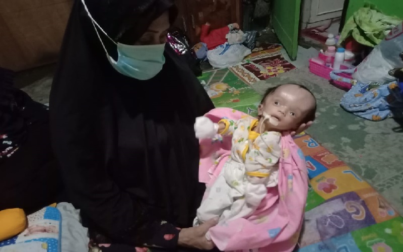 Nestapa Bayi Fauzian Idap Hidrosefalus dan Tangan Kiri Lumpuh 