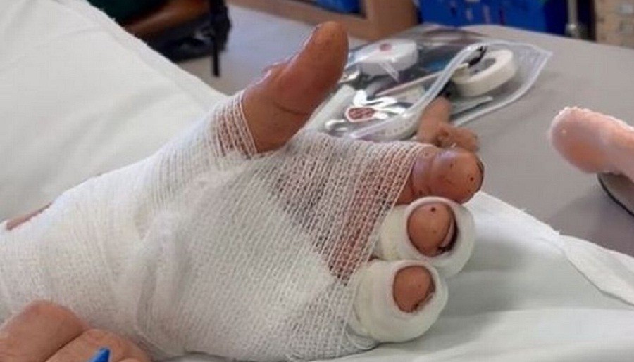 Sempat Putus, Tangan Pria Ini Berhasil Disambung Kembali setelah Operasi 11 Jam