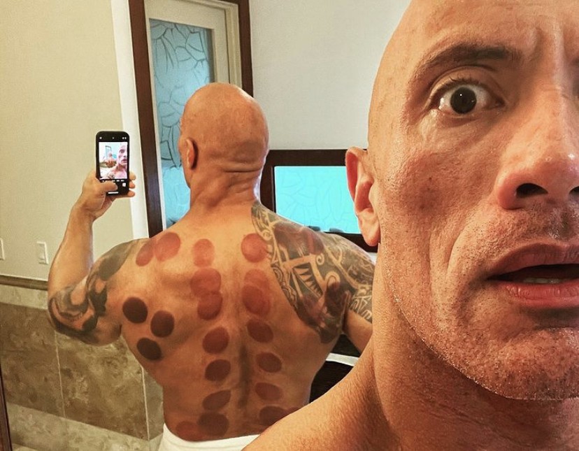 VJ Bani hingga Dwayne Johnson, Selebriti yang Coba Pengobatan Bekam