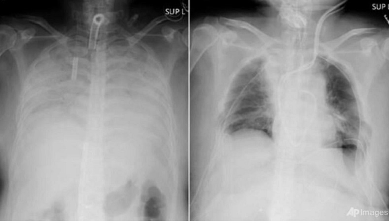  Pertama di Dunia, Pasien Covid Ini Terima Transplantasi Paru-Paru dari Suami dan Anaknya