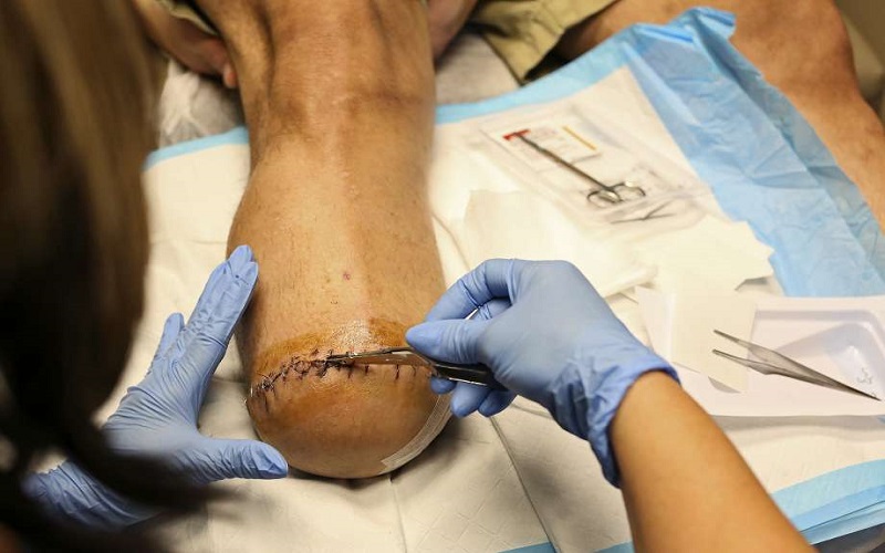 Duh, Dokter Salah Amputasi, Harusnya Kiri, Justru Kaki Kanan Pasien yang Dipotong