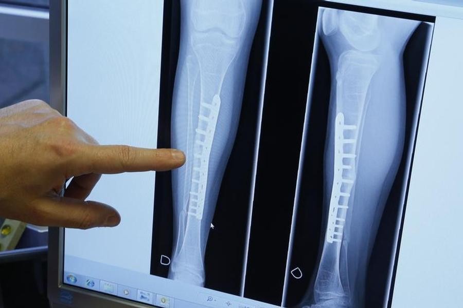 Lansia Bisa Cegah Osteoporosis dengan 5 Cara Ini, Salah Satunya Berhenti Merokok
