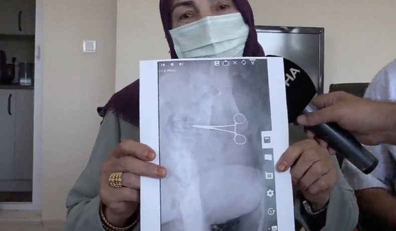 Ngeri, Gunting Bedah Tertinggal di Dalam Perut Perempuan Ini Pascaoperasi