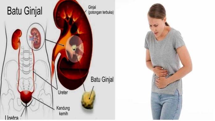 Kenali Gejala dan Mencegah Batu Ginjal, Penyakit yang Diderita Ashanty