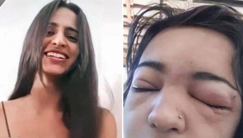 Nekat Tindik Alis Sendiri, Remaja Ini Tewas karena Infeksi 
