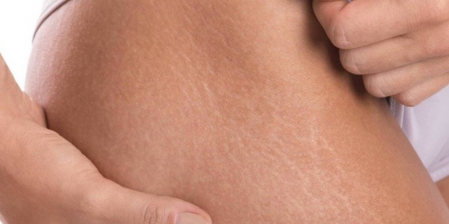 Ganggu Penampilan, Begini Cara Menghilangkan Garis Hitam di Perut