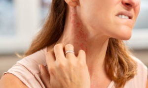 Kenali 4 Gejala Alergi Debu di Rumah, dari Bersin-Bersin hingga Ruam Merah