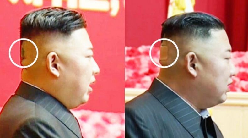 Kim Jong Un Terlihat Pakai Perban di Kepala, Ada Apa?