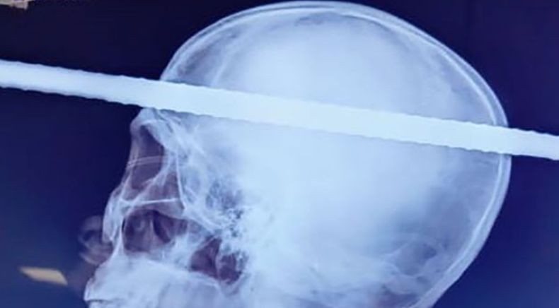 Ajaib, Pria Ini Selamat Setelah Besi Sepanjang 6 Meter Menembus Kepalanya