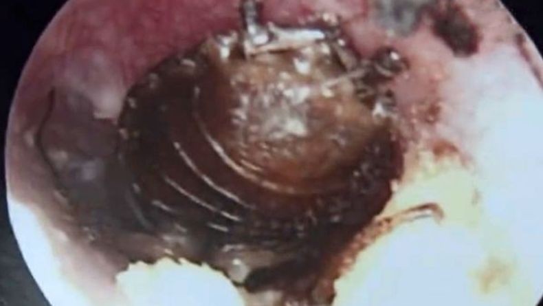 Kecoak Masuk Kuping Bocah Perempuan Ini, Bergerak ke Gendang Telinga