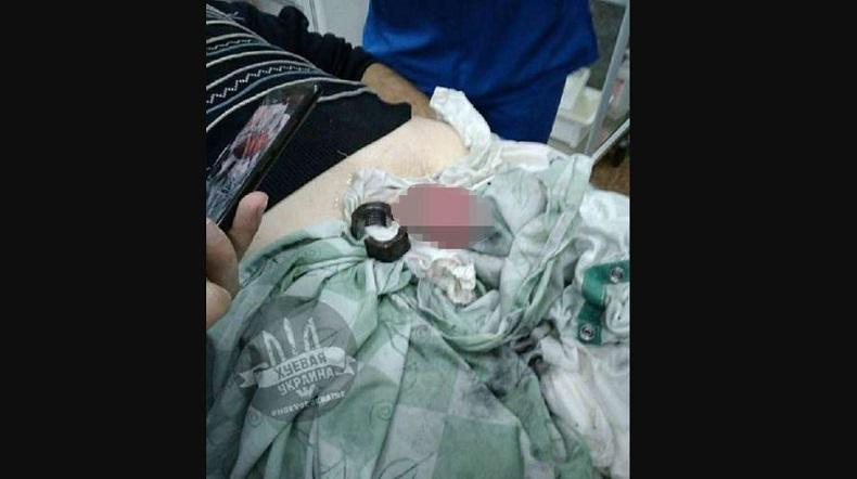 Cemburu Buta, Istri Pasang Mur Logam di Penis Suami yang Ketahuan Selingkuh