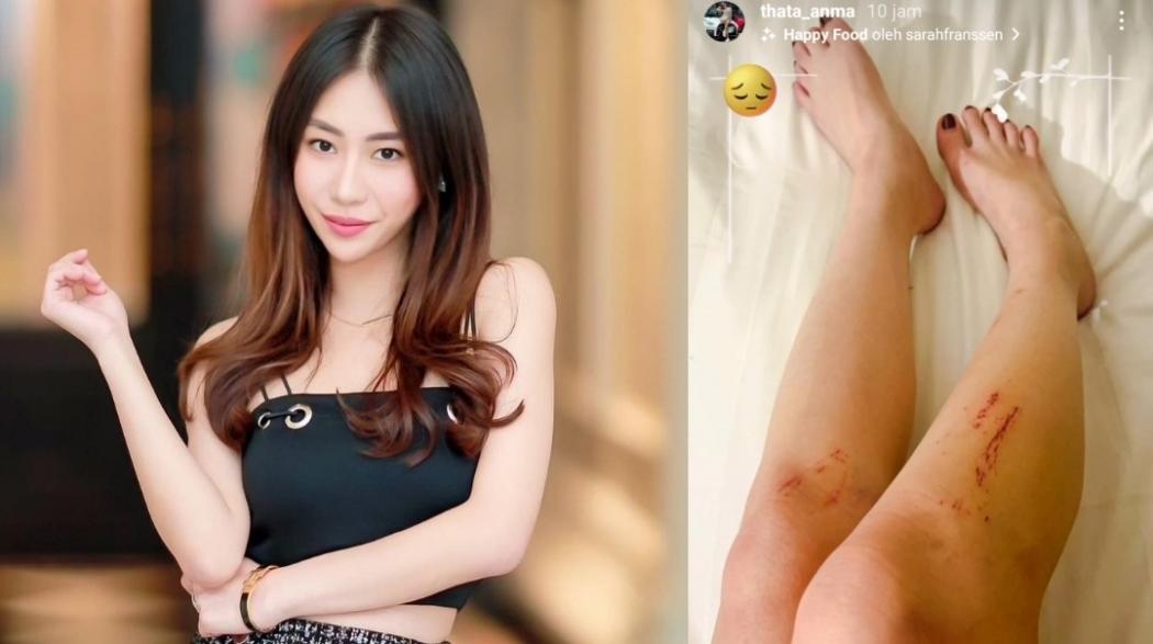 Perlihatkan Luka di Kaki, Ayu Thalia Laporkan Putra Ahok ke Polisi Dugaan Penganiayaan