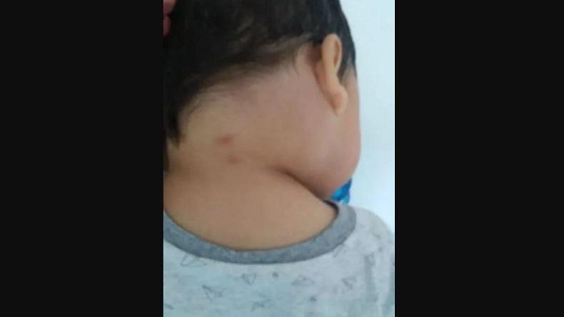 Sedih, Balita 2 Tahun Meninggal karena Gigitan Makhluk Misterius