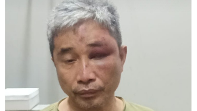 Lebam, Begini Tampang Muhammad Kece usai Dianiaya Irjen Napoleon Bonaparte