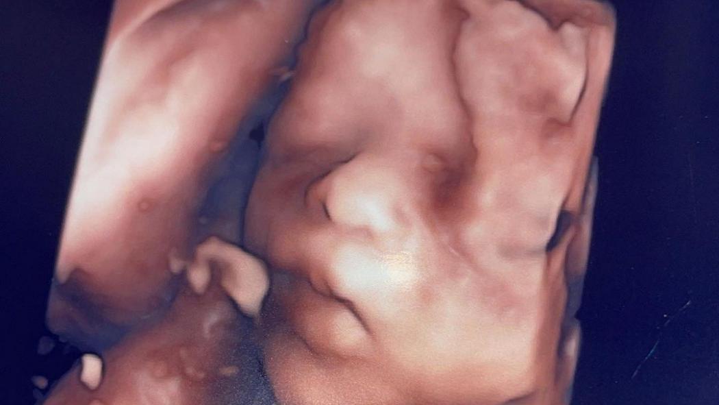 Unggah Foto USG, Bibir Anak Nathalie Holscher Mirip Sule
