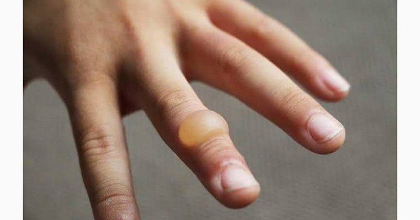 Waspada Epidermolysis Bullosa, Kelainan Kulit Langka yang Melepuh dan Kering