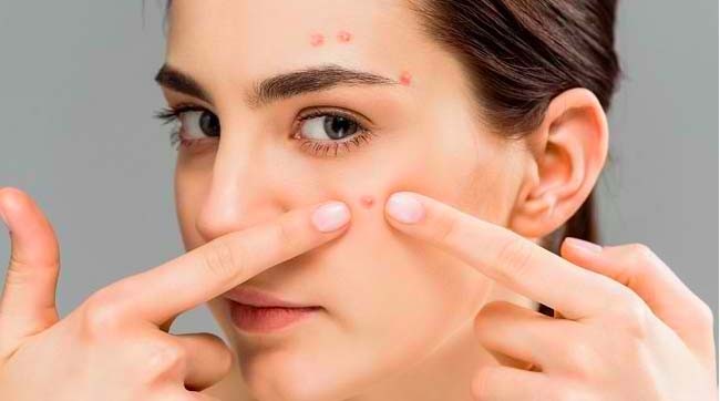 Apa Itu Chemical Peeling, Benarkah Bisa Menghilangkan Melasma dan Jerawat?