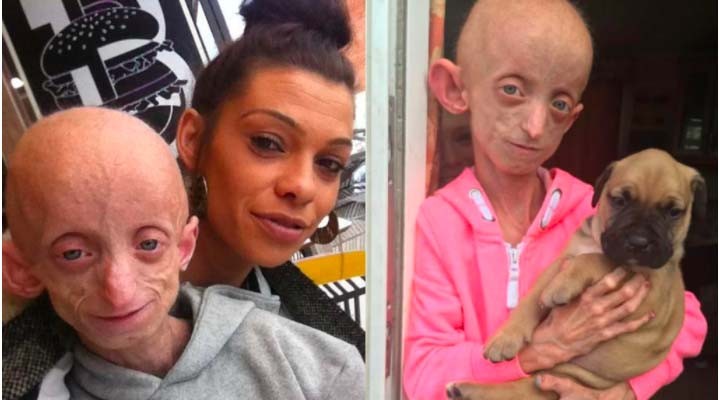 3 Orang Ini Mengidap Penyakit Langka di Dunia, Ada yang Meninggal Dunia