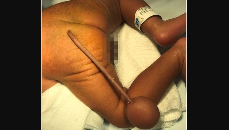Langka, Bayi Prematur Ini Lahir dengan Ekor Sepanjang 12 cm