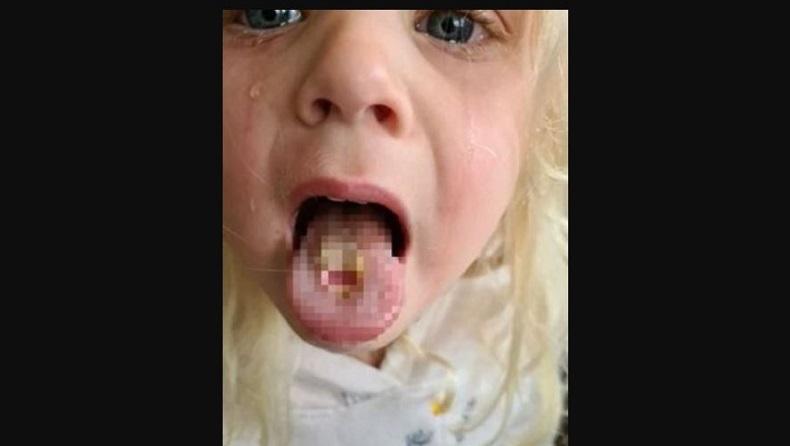 Duh, Lidah Bocah Ini Terbakar dan Mengelupas akibat Permen Asam