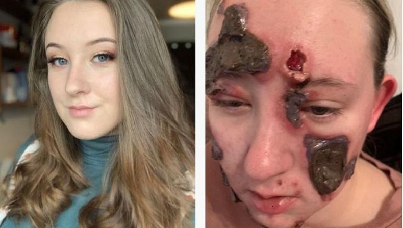 Derita Penyakit Aneh, Muka Remaja Putri Ini Penuh Koreng dan Nanah 