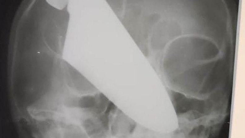 Ajaib, Wanita Ini Selamat Meski Kepala Ditusuk Pisau