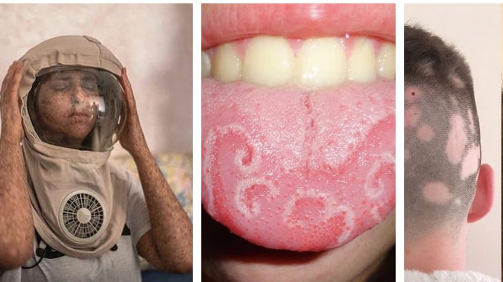 5 Penyakit Teraneh di Dunia, Ada yang Bikin Manusia Jadi Kayak Vampir