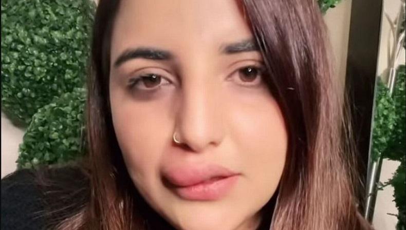 Waduh, Bibir TikToker Ini Besar Sebelah karena Tak Bisa Selesaikan Operasi Kosmetik