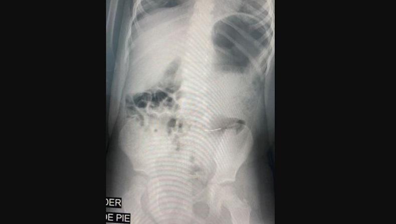 Duh, 2 Bocah Tak Sengaja Telan Logam yang Tersembunyi dalam Kue Ulang Tahun