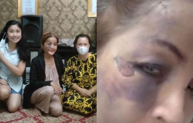 Kronologi Machica Mochtar Jadi Korban Tabrak Lari Angkot saat Naik Motor, Wajahnya Sampai Lebam 