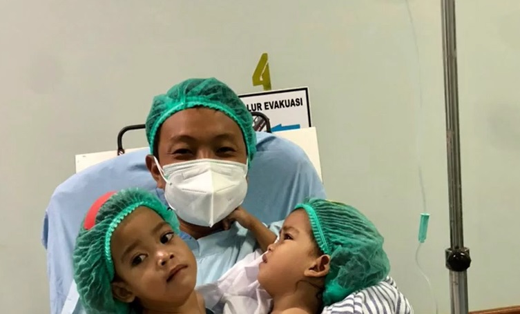 Menunggu 3 Tahun, Bayi Kembar Siam Inaya dan Anaya Akhirnya Sukses lewati Operasi Pemisahan