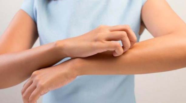 Waspada Jangan Anggap Remeh Penyakit Kulit Eksim, Bisa Timbulkan Peradangan Kronis