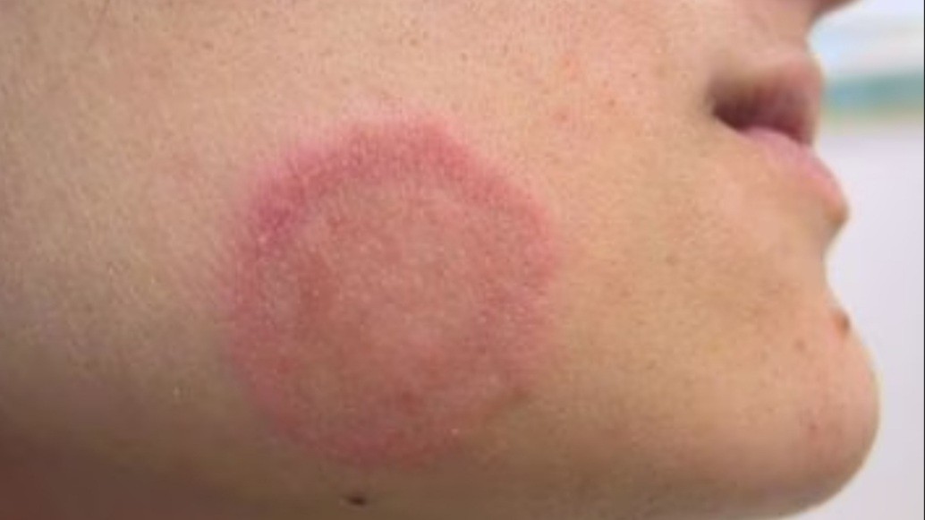 Cara Menghilangkan Panu Sampai ke Akarnya, Gampang hanya Pakai Salep Antijamur