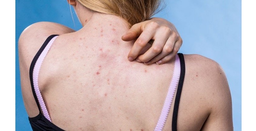 5 Penyebab Jerawat di Punggung, Bisa Timbul Jika Terlalu Banyak Mengonsumsi Olahan Susu