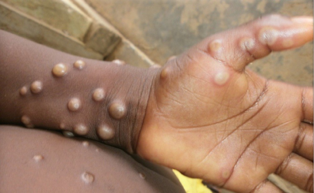 Usai Inggris dan Spanyol, Portugal Juga Temukan Kasus Orang Terinfeksi Cacar Monyet