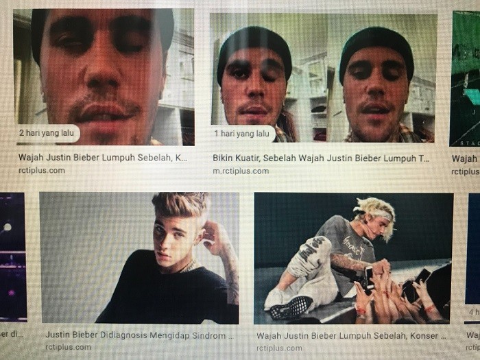 Bieber Tunda Konser Dunia karena Separuh Wajahnya Lumpuh