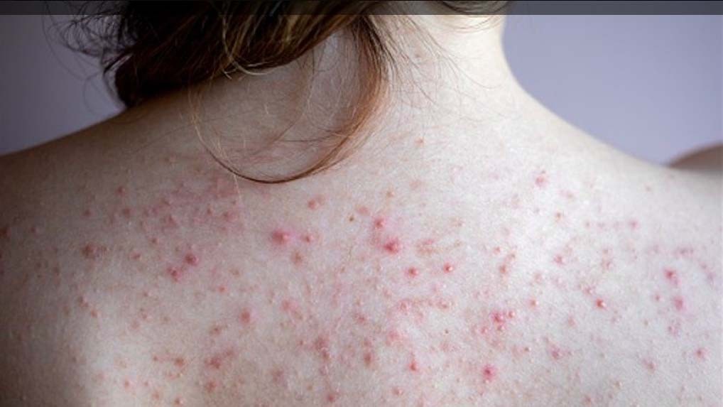 4 Penyebab Punggung Jerawatan, Bisa karena Hormon atau Keturunan