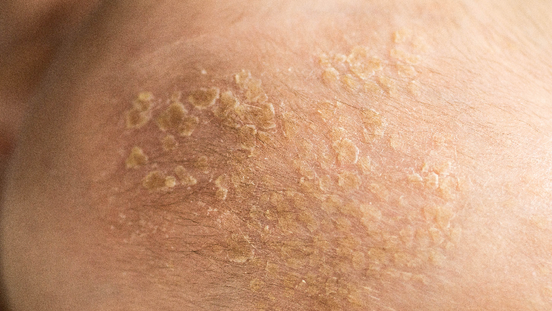 Ini Cara Mengobati Jamur Kulit yang Membandel, Jangan Panik!