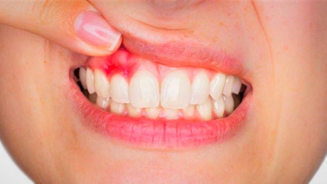 3 Cara Mengobati Gusi Bengkak, Bisa Pakai Lidah Buaya hingga Air Garam