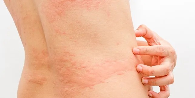 3 Cara Mengobati Biduran, Hindari Kompres Air Panas