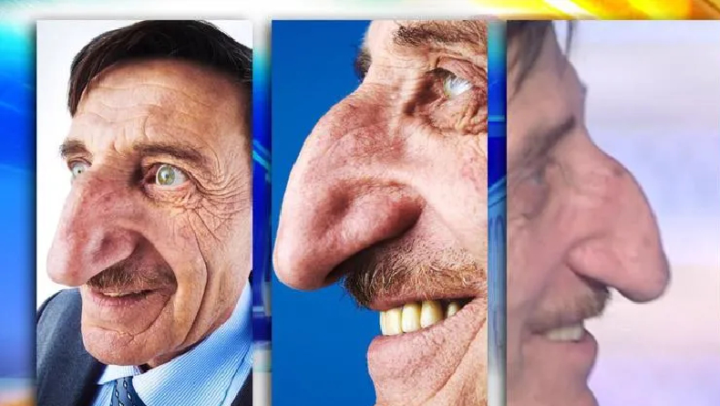 Mehmet Ozyurek, Pria yang Mempunyai Hidung Terpanjang 8,8 Cm Asal Turki