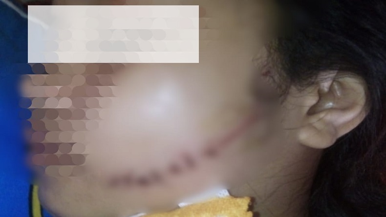 Pipi Kiri Remaja Putri di Indramayu Robek akibat Dianiaya Teman, Diduga gegara Berebut Pacar