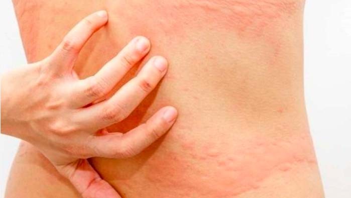 Cara Mengobati Biduran Agar Tak Kambuh Lagi, Hindari Pakaian Ketat