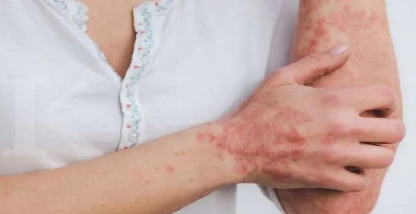 3 Cara Mengobati Kurap yang Sudah Lebar, Pakai Lidah Buaya hingga Kunyit