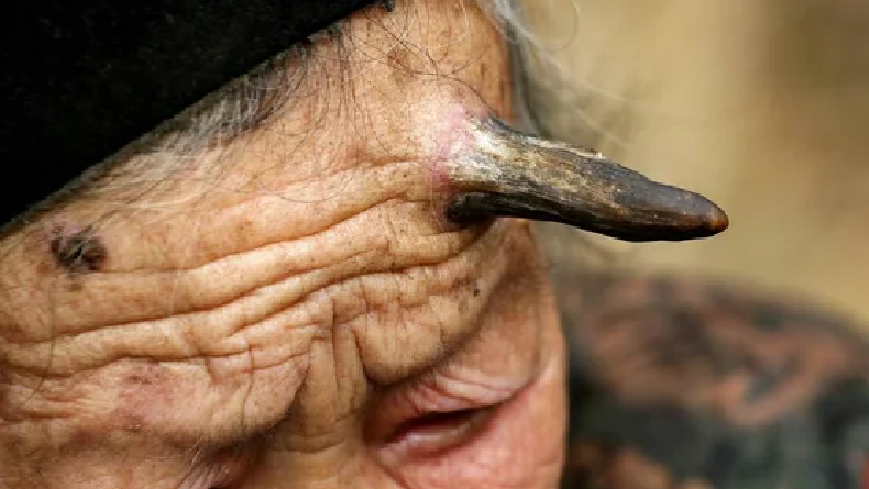 Zhang Ruifang, Wanita Tua Asal Cina yang Punya Tanduk Setan di Dahinya 