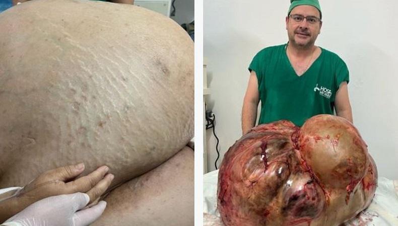 Ngeri, Pasien Ini Punya Tumor Seberat 45 Kg di Dalam Perut