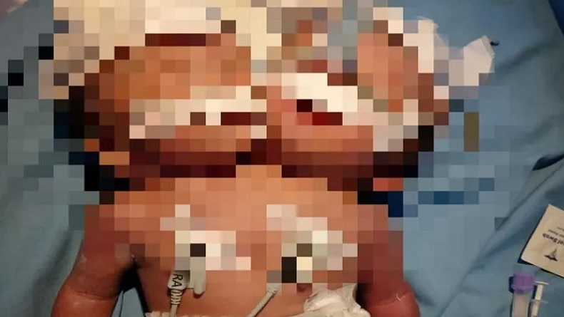 Bayi Kembar Siam 2 Kepala Satu Badan Terlahir di Padang Pariaman, Begini Kondisinya
